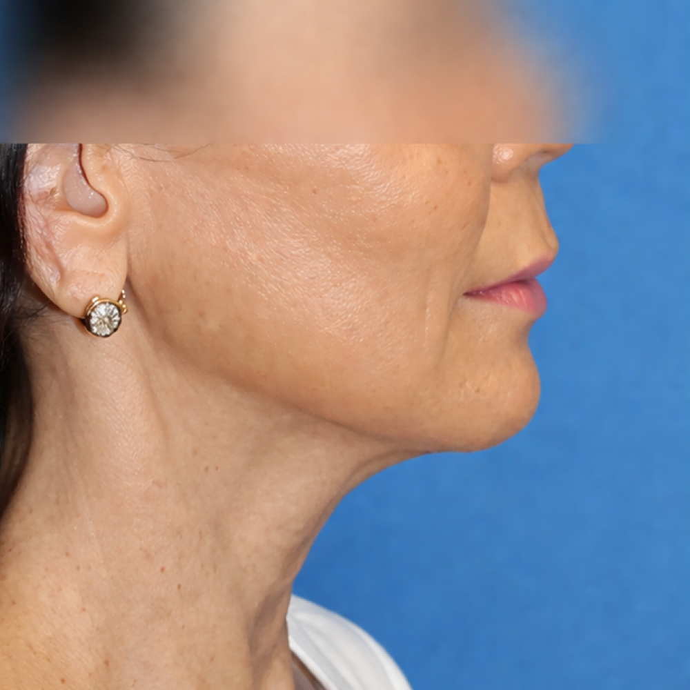 Before/After Image